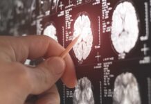 A hand pointing at a brain MRI scan on a screen