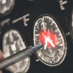 Hidden Gene Sabotages Cancer Treatment A hand pointing at a brain scan with highlighted areas